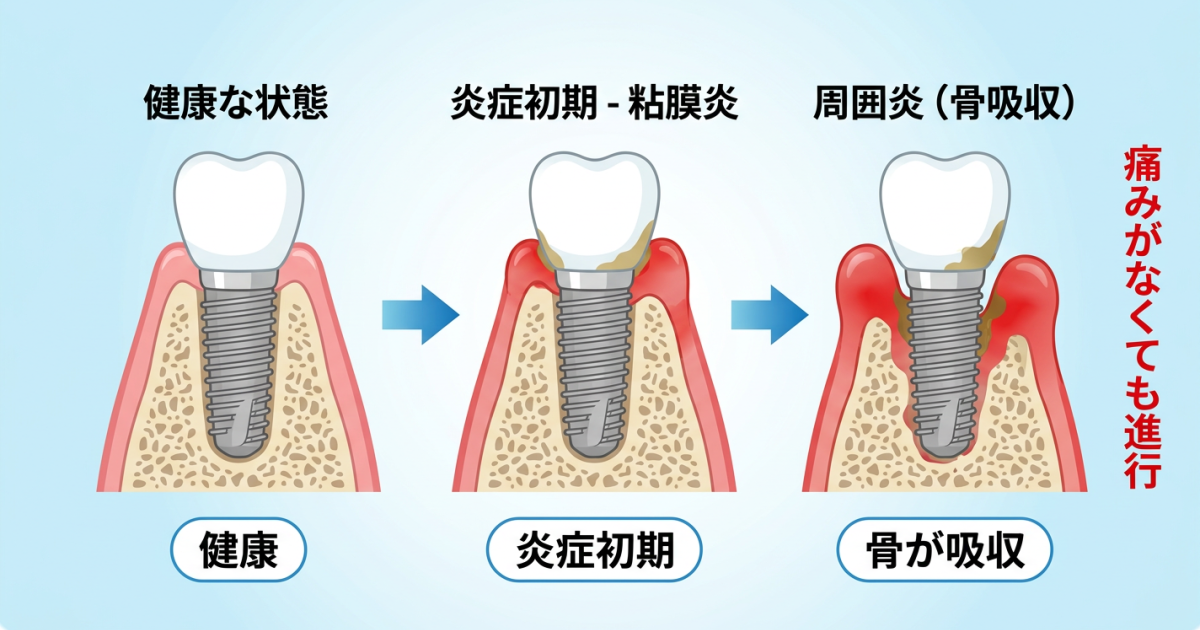 ■インプラントのメンテナンスに行かないと起こる3つのリスク
