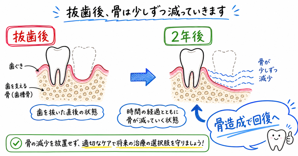 抜歯を2年放置して後悔…今からでもインプラントはできる？
