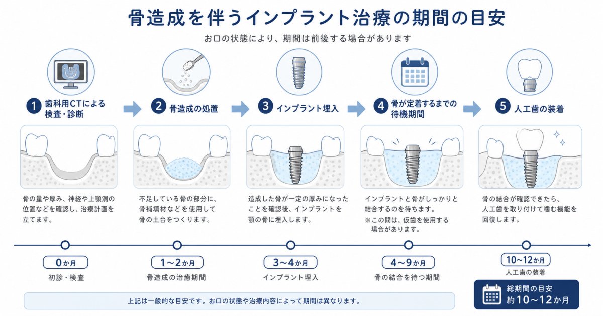 骨造成ありのインプラント治療期間は？完了までの全ステップ解説