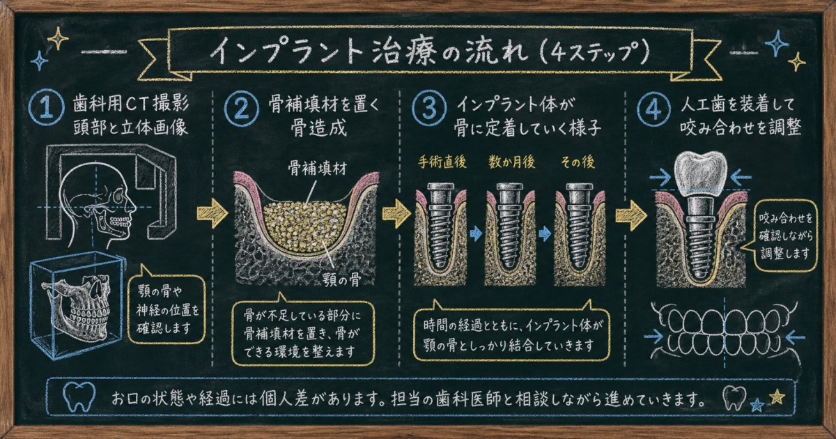 骨造成ありのインプラント治療にかかる全体期間と通院ペースの目安