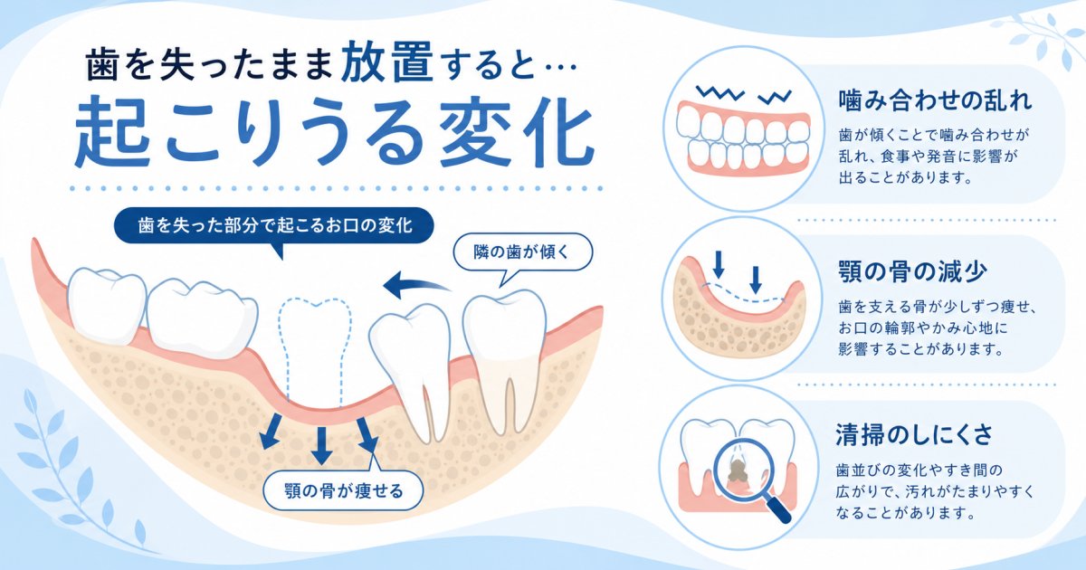 30代・40代で歯を失った際に生じる放置リスクと口腔環境の変化