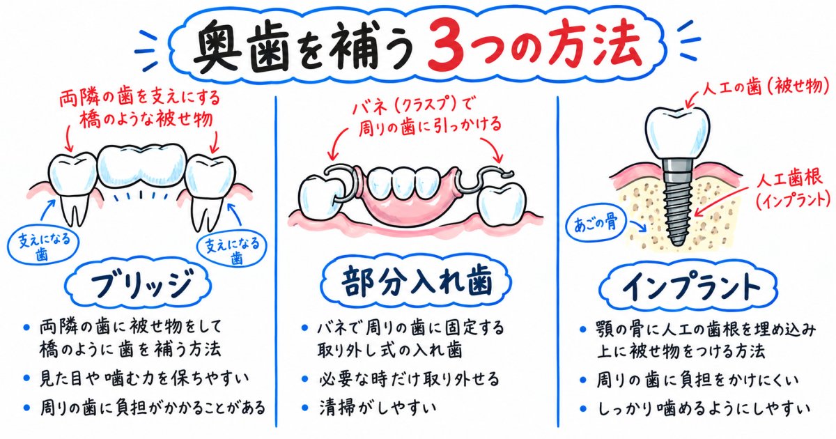 失った奥歯を補う3つの選択肢と治療特徴の整理