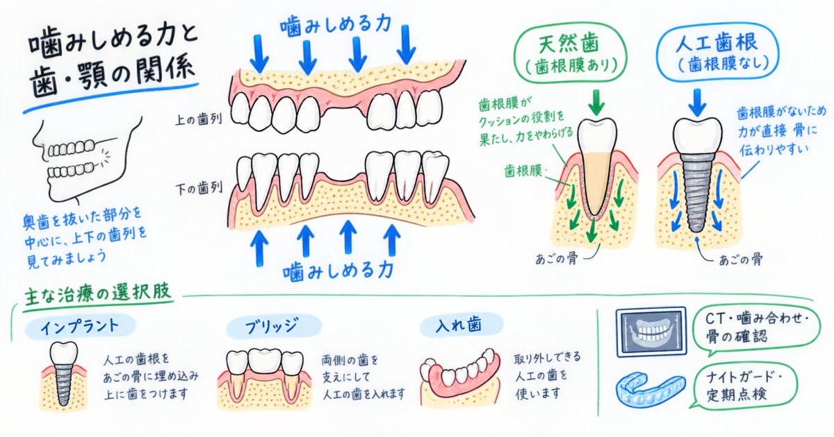 食いしばりで抜歯後、インプラントは可能？ほかの治療も考える