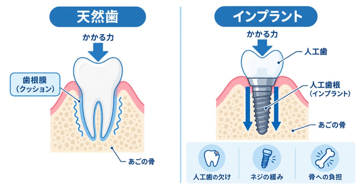 食いしばりがあると、抜歯後のインプラントは難しい？